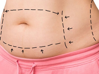 Abdominoplasty