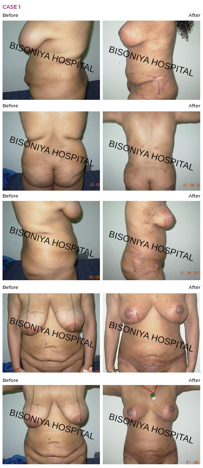 Abdominoplasty - Case1