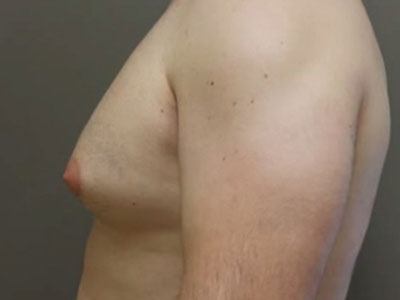 Gynecomastia