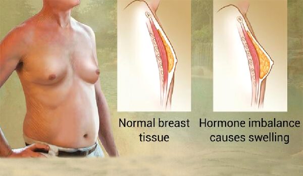 Gynecomastia