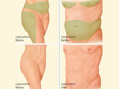 Liposuction